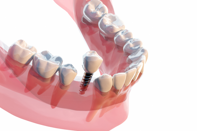 インプラント治療の流れ