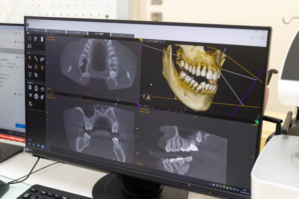 インプラントとは？